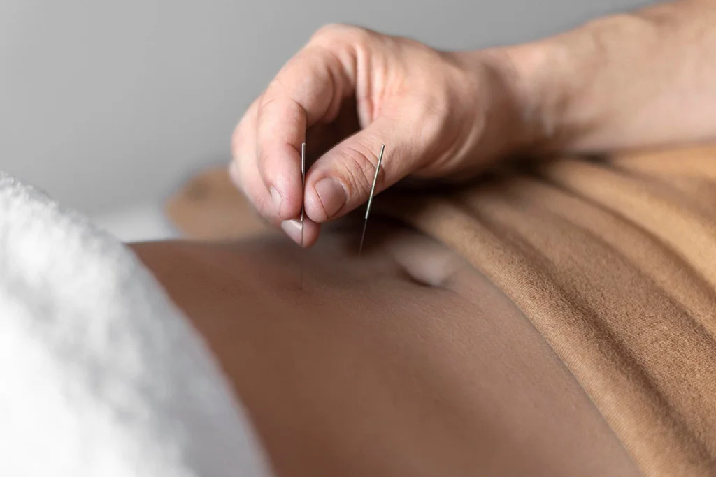 Get Relief from Muscle Pain and Tension with Dry Needling in Richmond