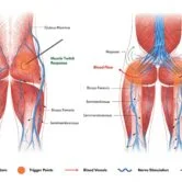 Anatomical illustration showing trigger points in muscles and effects of dry needling treatment