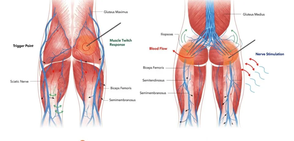 Anatomical illustration showing trigger points in muscles and effects of dry needling treatment
