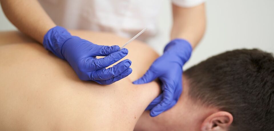 dry needling benefits