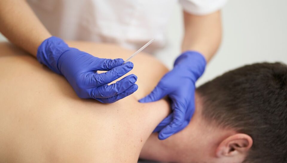 dry needling benefits